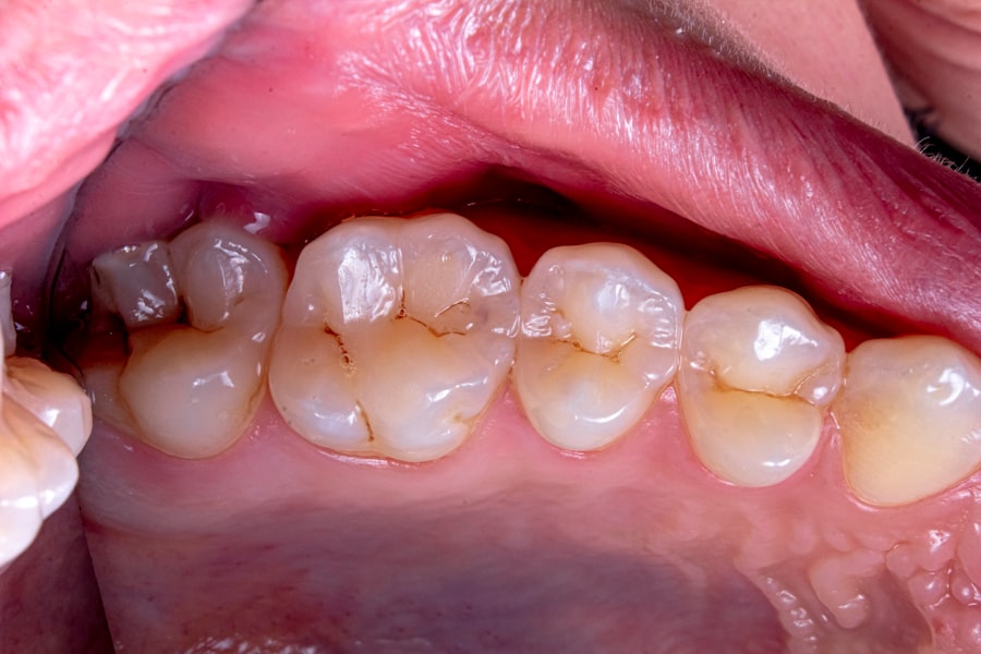 Tooth falling